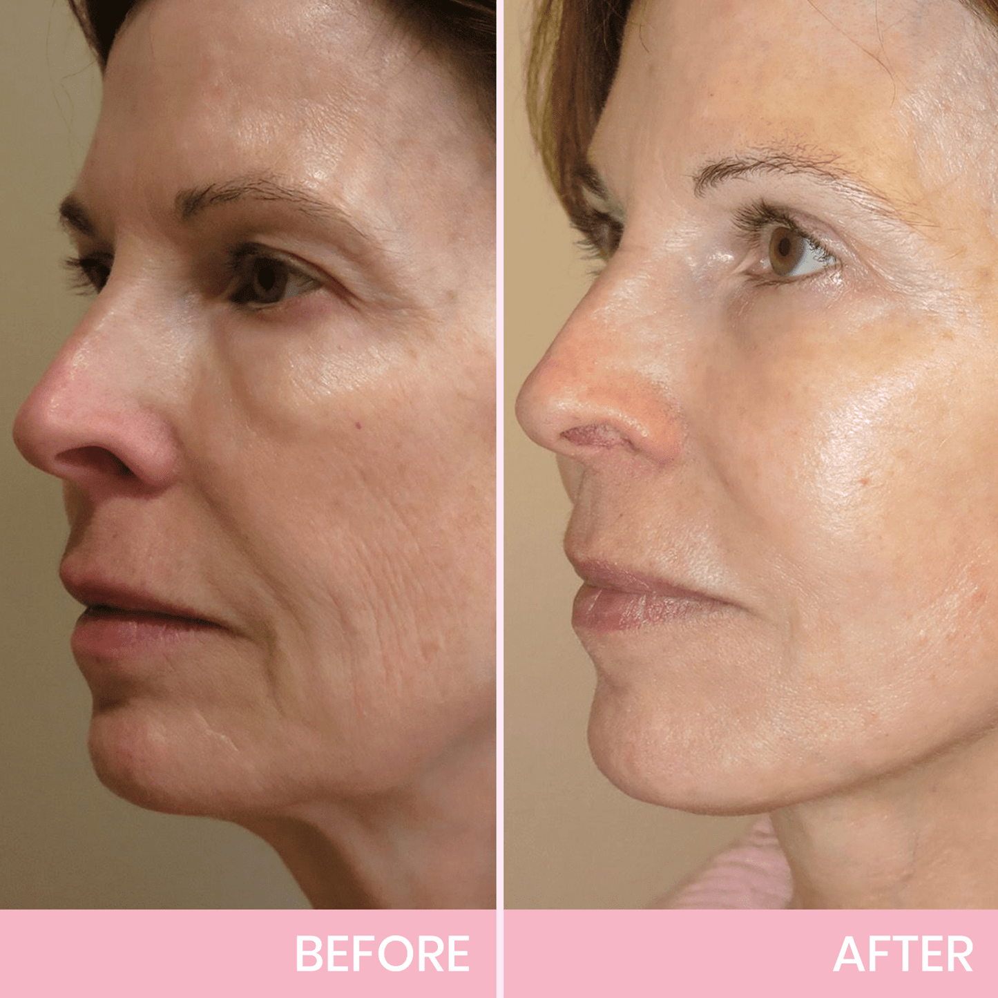 💖🎁Last Day 50% OFF-LBMLBM™ V-Face Lifting Invisible Adhesive Tape