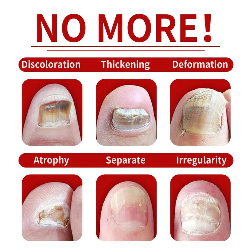 💅Refuse nail rot, ginger nail treatment👣