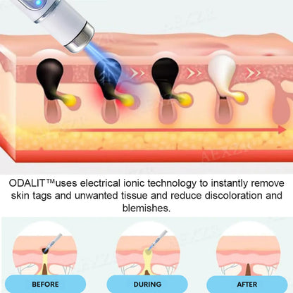 💥ODALIT™ Non-Invasive Mole and Wart Removal Laser Pen