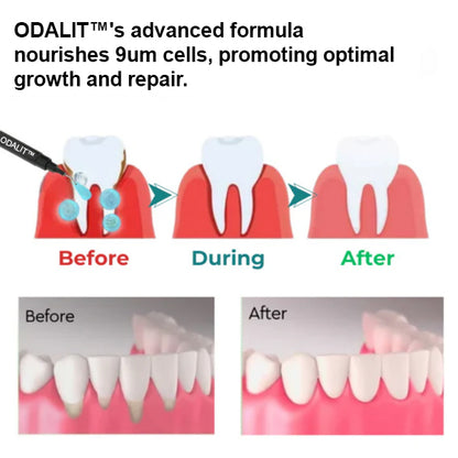 💖🦷ODALIT™ Gum Therapy Agent🔥