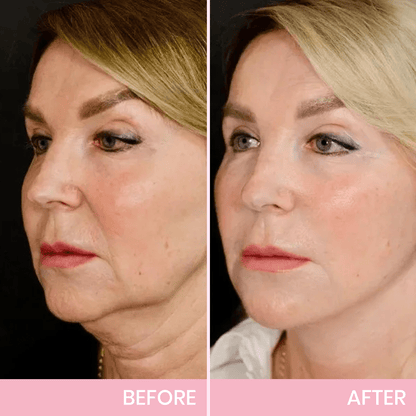 💖🎁Last Day 50% OFF-LBMLBM™ V-Face Lifting Invisible Adhesive Tape