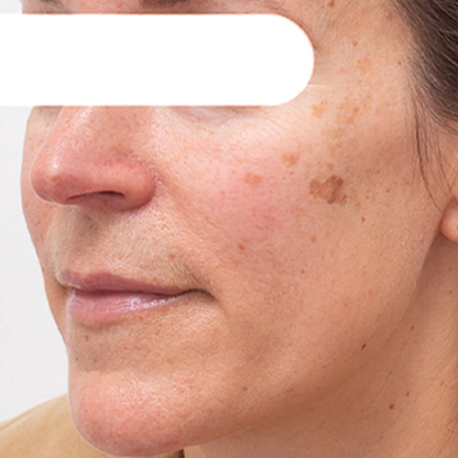 ODALIT™ Herbal Spots ✅ 𝕤𝕒𝕧𝕖 𝕦𝕡 𝕥𝕠 𝟟𝟘% Peel-Off Facial Mask