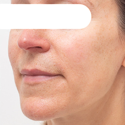 ODALIT™ Herbal Spots ✅ 𝕤𝕒𝕧𝕖 𝕦𝕡 𝕥𝕠 𝟟𝟘% Peel-Off Facial Mask