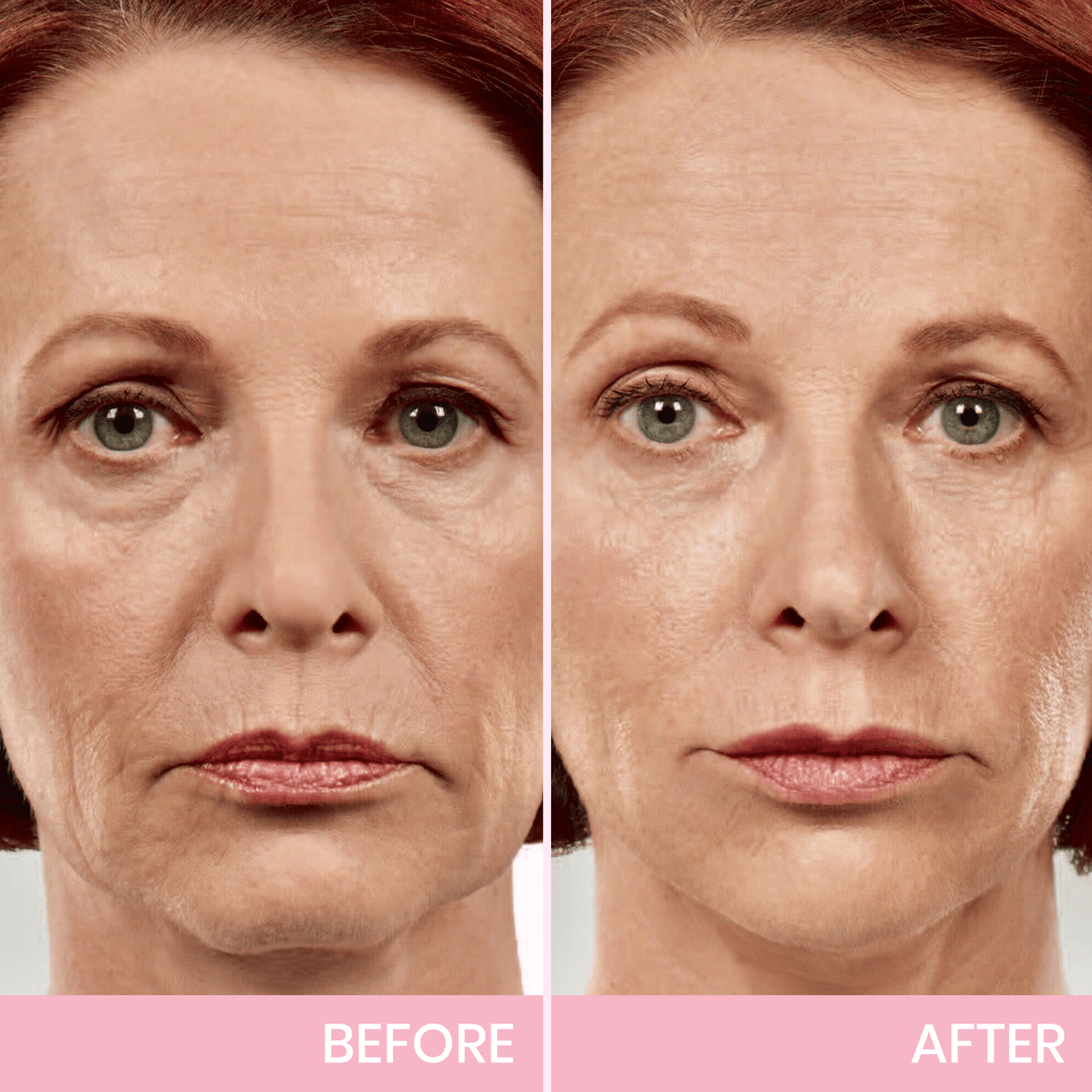 💖🎁Last Day 50% OFF-LBMLBM™ V-Face Lifting Invisible Adhesive Tape