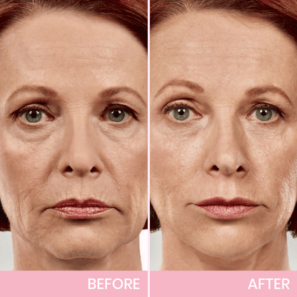 💖🎁Last Day 50% OFF-LBMLBM™ V-Face Lifting Invisible Adhesive Tape