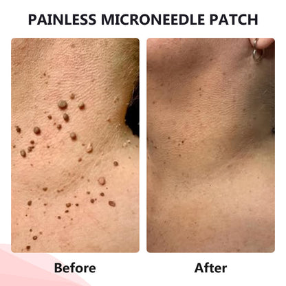 💥ODALIT™ painless micro-patch🔥🔥