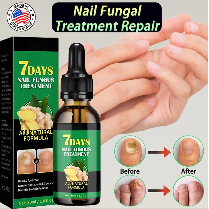 💅Refuse nail rot, ginger nail treatment👣