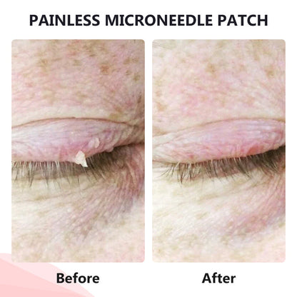 💥ODALIT™ painless micro-patch🔥🔥